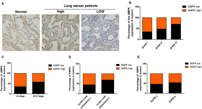 Low levels of AMPK promote epithelial-mesenchymal transition in lung cancer primarily through HDAC4- and HDAC5-mediated metabolic reprogramming.