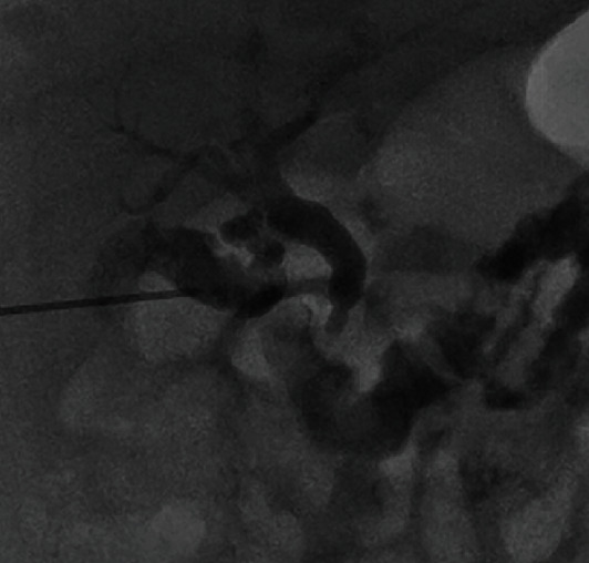 Single Procedure Saline Lavage for Treatment of Inspissated Bile.