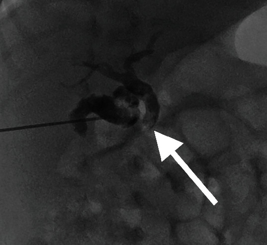 Single Procedure Saline Lavage for Treatment of Inspissated Bile.