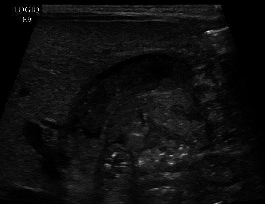 Single Procedure Saline Lavage for Treatment of Inspissated Bile.