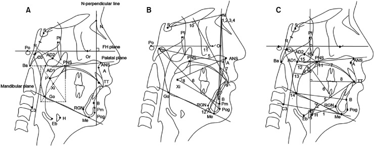 Effects of the long-term use of maxillary protraction facemasks with skeletal anchorage on pharyngeal airway dimensions in growing patients with cleft lip and palate.