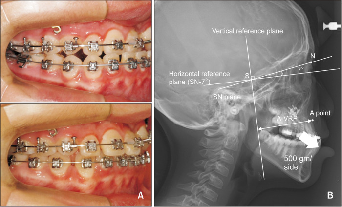 Effects of the long-term use of maxillary protraction facemasks with skeletal anchorage on pharyngeal airway dimensions in growing patients with cleft lip and palate.