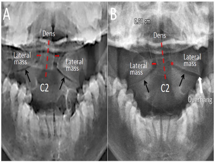 Atlantoaxial Rotatory Subluxation in a 10-Year-Old Boy.