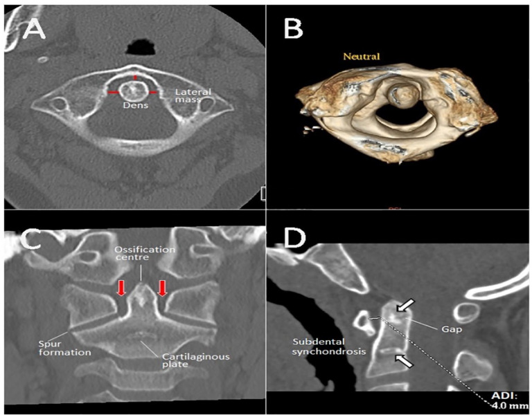 Atlantoaxial Rotatory Subluxation in a 10-Year-Old Boy.