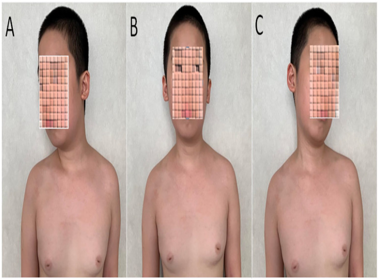 Atlantoaxial Rotatory Subluxation in a 10-Year-Old Boy.