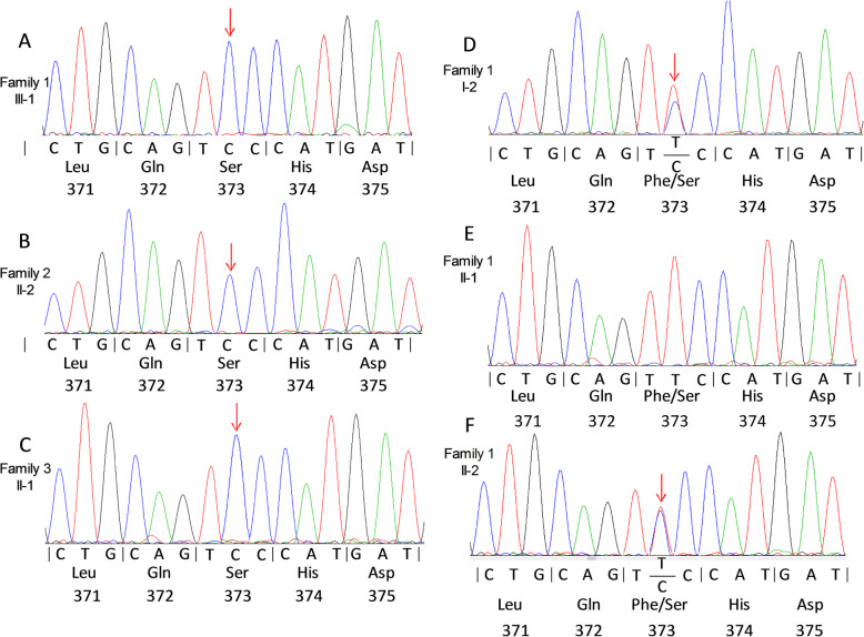 A novel G6PD deleterious variant identified in three families with severe glucose-6-phosphate dehydrogenase deficiency.