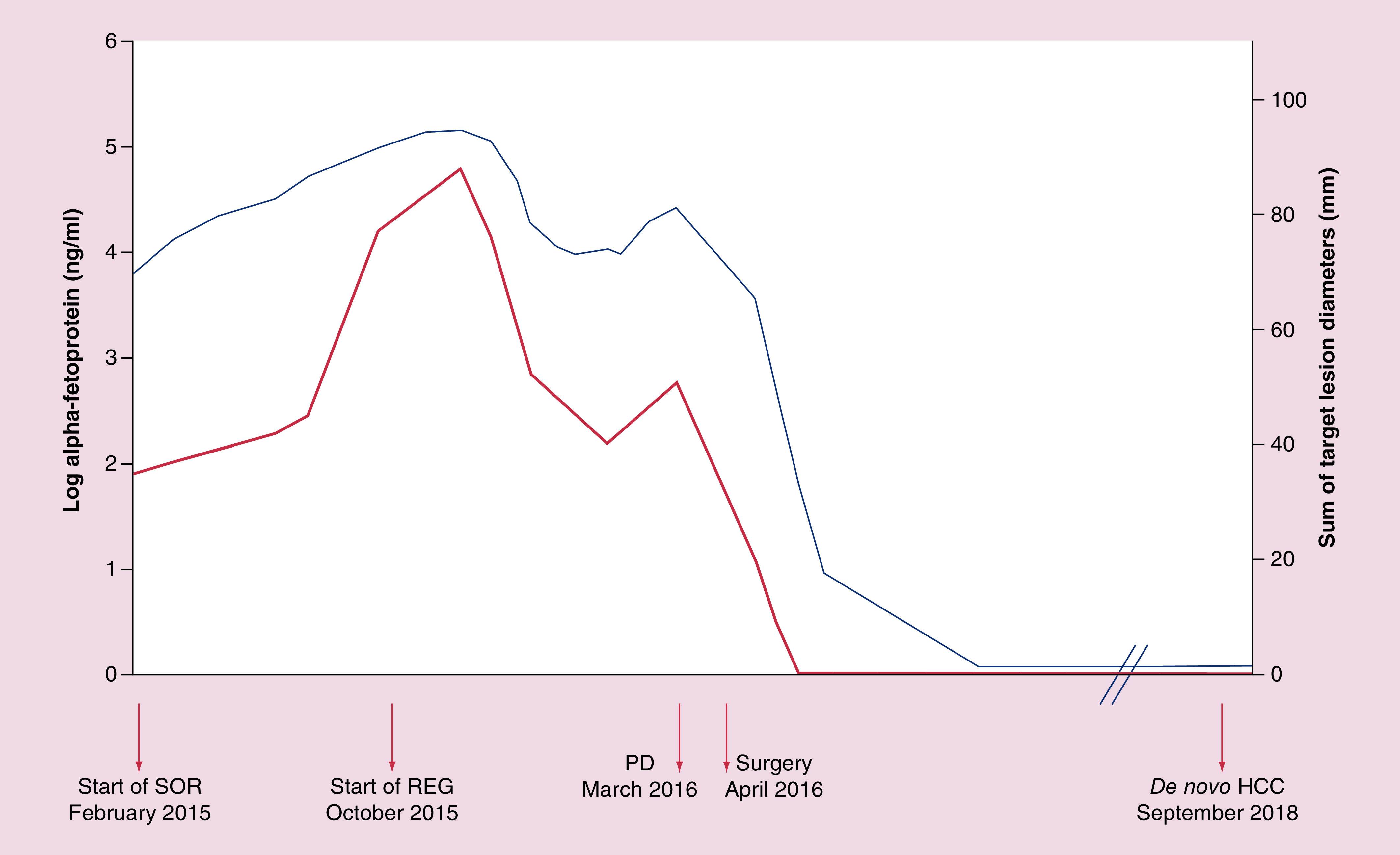 Long-lasting remission in a metastatic hepatocellular carcinoma patient after combined regorafenib therapy and surgery.