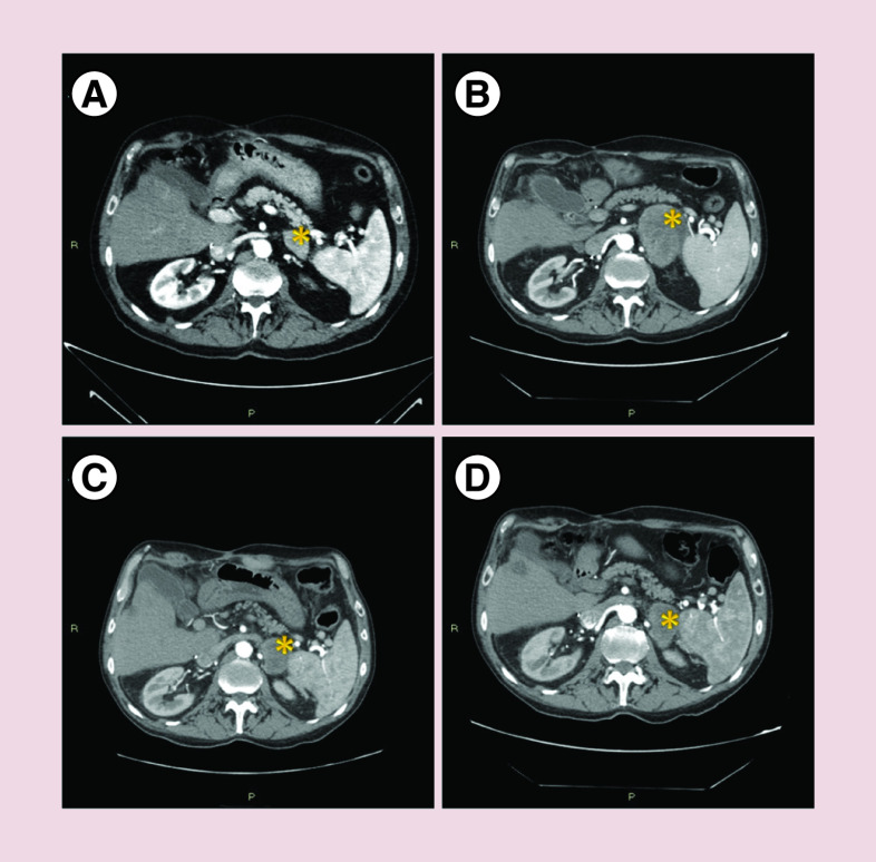 Long-lasting remission in a metastatic hepatocellular carcinoma patient after combined regorafenib therapy and surgery.