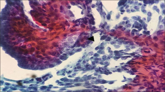 A Comparative Study of Fine-Needle Aspiration and Nonaspiration Cytology Diagnosis in Thyroid Lesions.