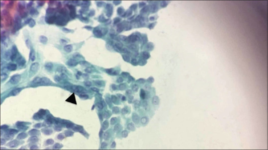 A Comparative Study of Fine-Needle Aspiration and Nonaspiration Cytology Diagnosis in Thyroid Lesions.