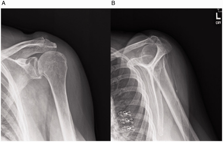 Case Report: Watching and Waiting? A Case of Incomplete Glenosphere Seating With Spontaneous Reversal in Reverse Shoulder Arthroplasty.