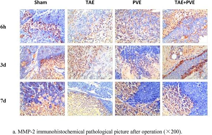 Expression of MMP-2 in residual VX2 liver tumor after transcatheter arterial embolization combined with portal venous embolization in an animal model