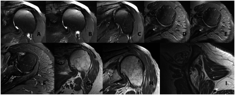 Case Report: Watching and Waiting? A Case of Incomplete Glenosphere Seating With Spontaneous Reversal in Reverse Shoulder Arthroplasty.