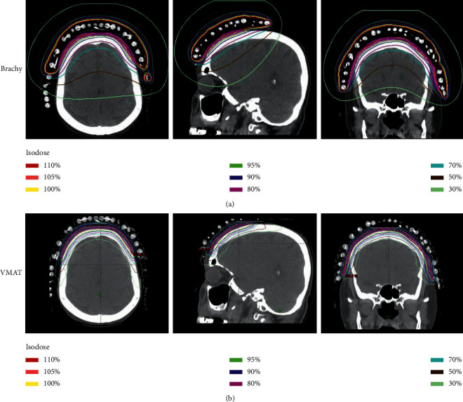 Angiosarcoma of the Scalp and Face: A Dosimetric Comparison of HDR Surface Applicator Brachytherapy and VMAT.