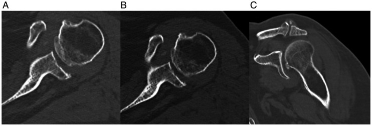 Case Report: Watching and Waiting? A Case of Incomplete Glenosphere Seating With Spontaneous Reversal in Reverse Shoulder Arthroplasty.