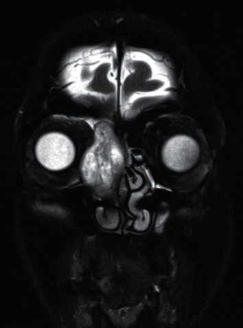 Metal-Working Fluids Exposure and a Rare Frontoethmoid Lesion.