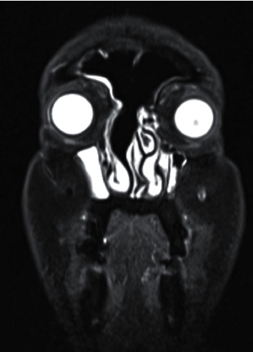 Metal-Working Fluids Exposure and a Rare Frontoethmoid Lesion.