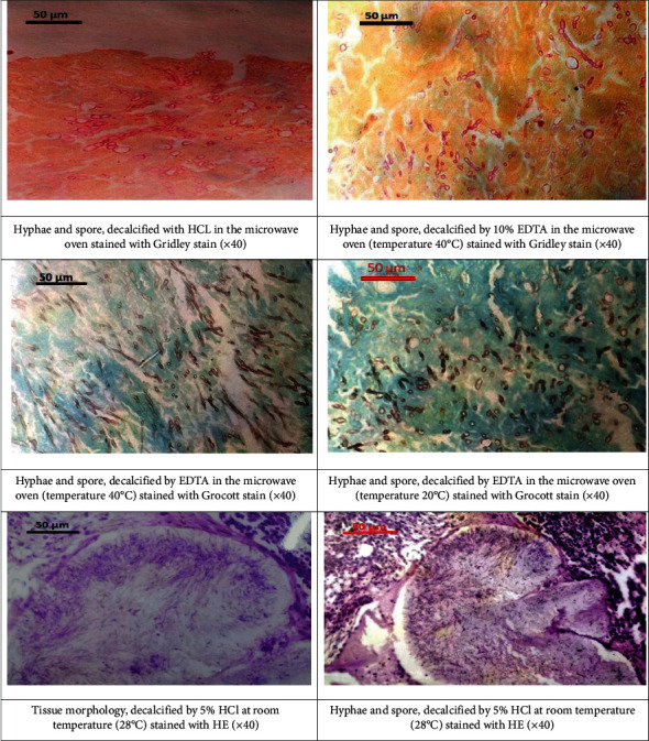 Comparison between Conventional Decalcification and a Microwave-Assisted Method in Bone Tissue Affected with Mycetoma.