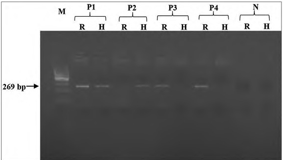 Implication of <i>VDR</i> Rs7975232 and <i>FCGR2A</i> Rs1801274 Gene Polymorphisms in the Risk and the Prognosis of autoimmune Thyroid Diseases in the Tunisian Population.