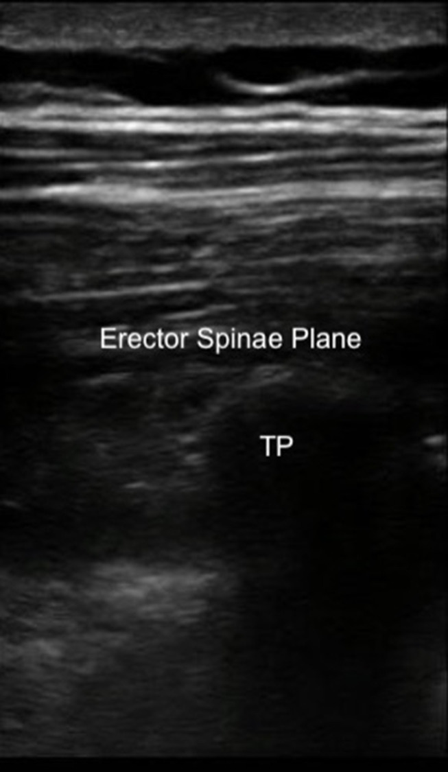 Postoperative "Rescue" Use of Erector Spinae Plane Block After Lumbar Spine Fusion: A Report of 2 Cases.