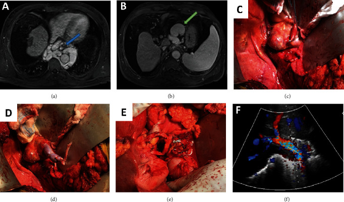 Techniques for Management of Portal Vein Thrombosis during Liver Transplantation.