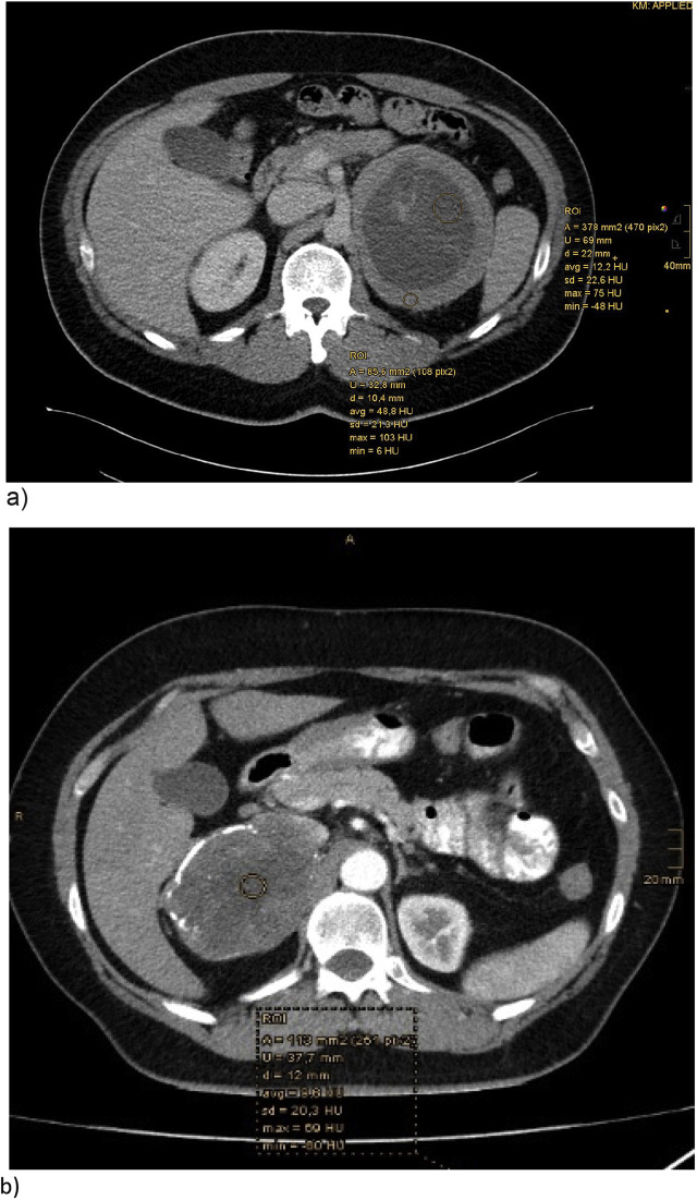 Two giant retroperitoneal schwannomas mimicking adrenal malignancy - a case report.