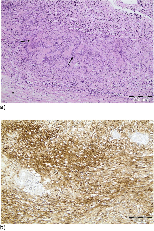 Two giant retroperitoneal schwannomas mimicking adrenal malignancy - a case report.