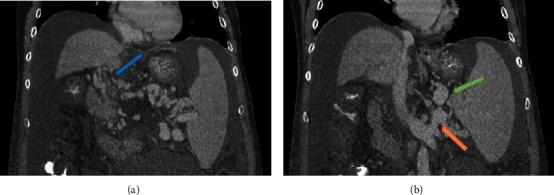 Techniques for Management of Portal Vein Thrombosis during Liver Transplantation.