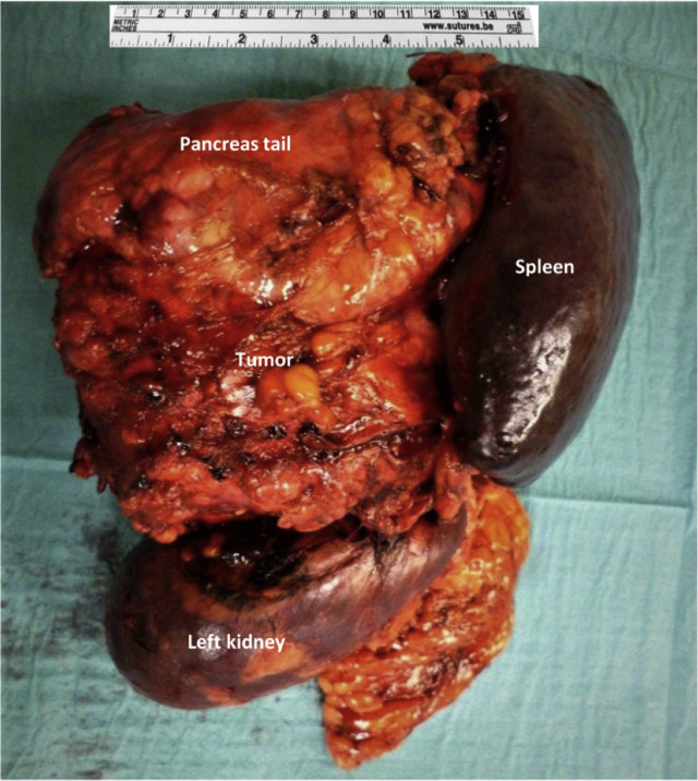 Two giant retroperitoneal schwannomas mimicking adrenal malignancy - a case report.