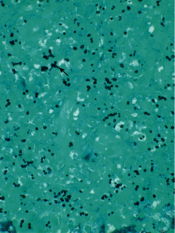A Case of Hemophagocytic Lymphohistiocytosis Secondary to Disseminated Histoplasmosis.