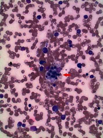 A Case of Hemophagocytic Lymphohistiocytosis Secondary to Disseminated Histoplasmosis.