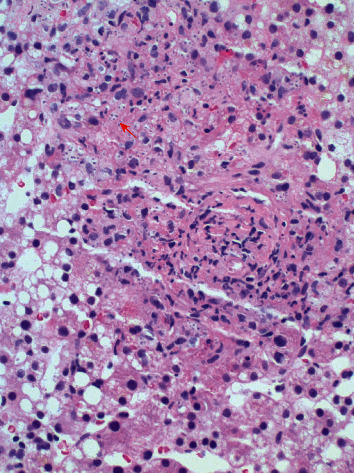 A Case of Hemophagocytic Lymphohistiocytosis Secondary to Disseminated Histoplasmosis.