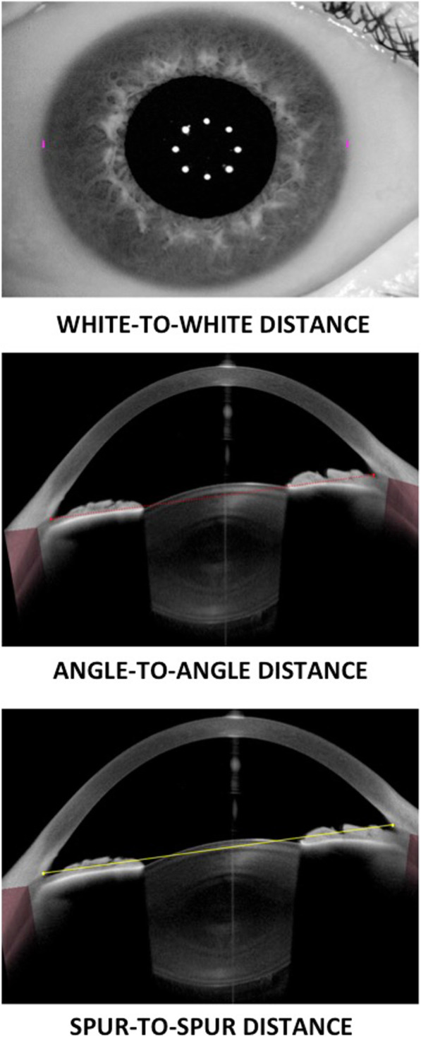 Angle-to-angle and spur-to-spur distance analysis with high-resolution optical coherence tomography.