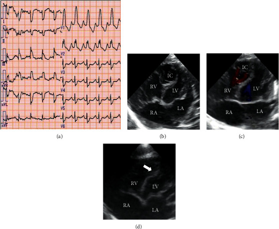 A Japanese Patient with Genitopatellar Syndrome Transiently Presenting with Cardiac Intramural Cavity during the Neonatal Period.