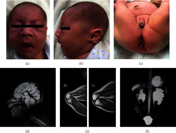 A Japanese Patient with Genitopatellar Syndrome Transiently Presenting with Cardiac Intramural Cavity during the Neonatal Period.