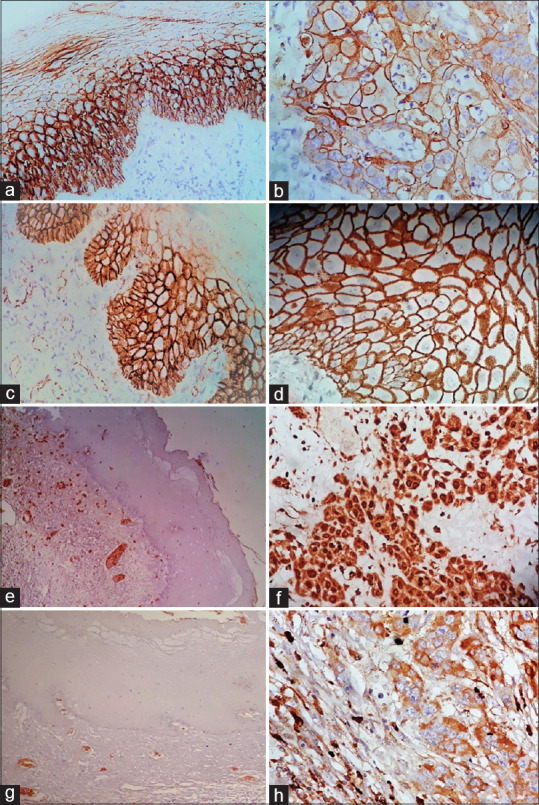 Prediction of metastasis in oral squamous cell carcinoma through phenotypic evaluation and gene expression of E-cadherin, β-catenin, matrix metalloproteinase-2, and matrix metalloproteinase-9 biomarkers with clinical correlation.