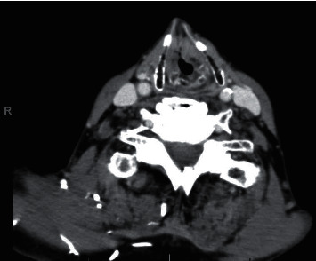 Mucosa-Associated Lymphoid Tissue Lymphoma of the Larynx.