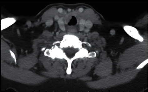 Mucosa-Associated Lymphoid Tissue Lymphoma of the Larynx.