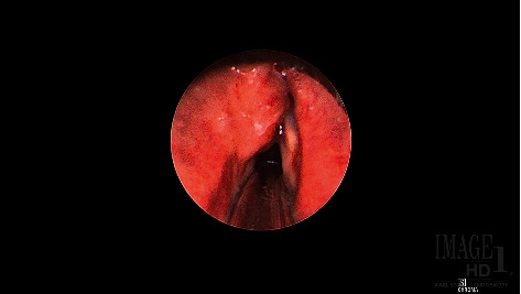 Mucosa-Associated Lymphoid Tissue Lymphoma of the Larynx.