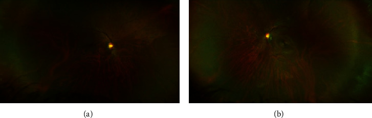 Eye Manifestations of Shprintzen-Goldberg Craniosynostosis Syndrome: A Case Report and Systematic Review.