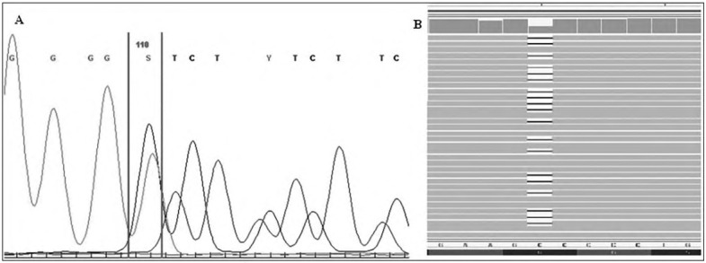 <i>De Novo KMT2D</i> Heterozygous Frameshift Deletion in a Newborn with a Congenital Heart Anomaly.