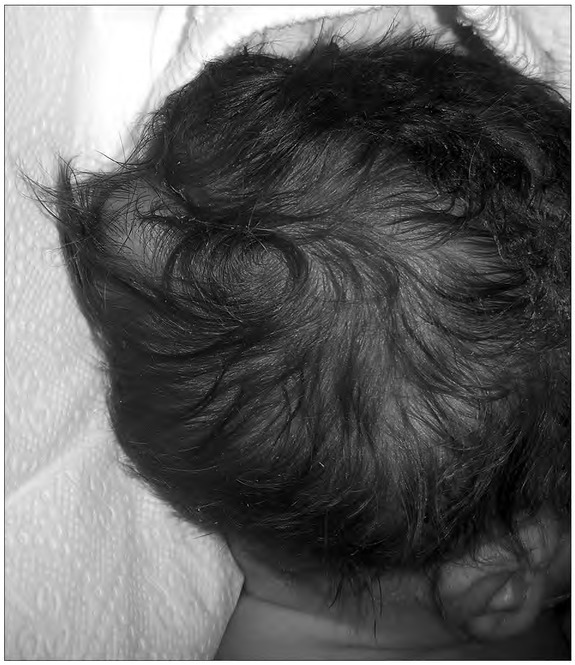 Prenatal Diagnosis of <i>a De Novo</i> Partial Trisomy 6q and Partial Monosomy 18p Associated with Cephalocele: A Case Report.