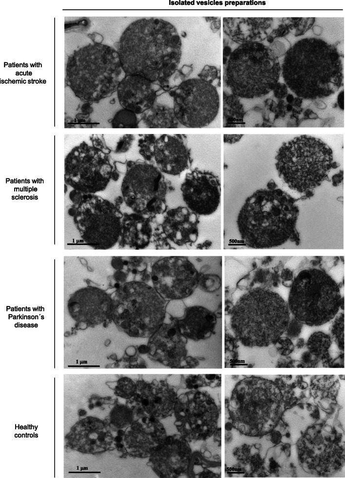 Isolation and Quantification of Blood Apoptotic Bodies, a Non-invasive Tool to Evaluate Apoptosis in Patients with Ischemic Stroke and Neurodegenerative Diseases.