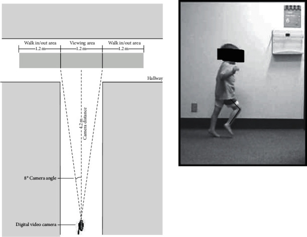 Minimally Invasive SPML Surgery for Children with Cerebral Palsy: Program Development.