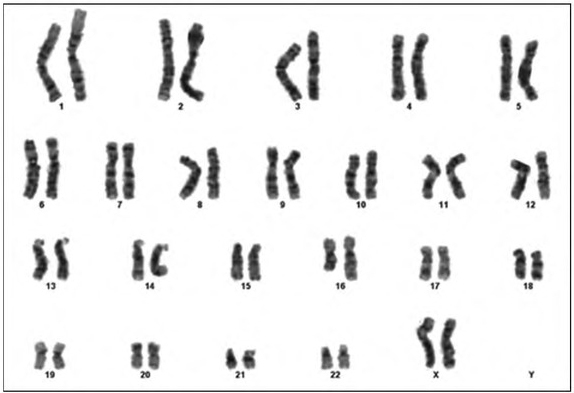 A Very Rare Partial Trisomy Syndrome: <i>De Novo</i> Duplication of 16q12.1q23.3 in a Turkish Girl with Developmental Delay and Facial Dysmorphic Features.