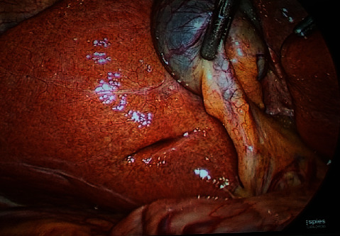 Anatomy of Rouviere's Sulcus and Its Association with Complication of Laparoscopic Cholecystectomy.