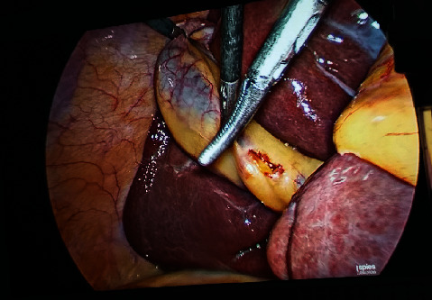 Anatomy of Rouviere's Sulcus and Its Association with Complication of Laparoscopic Cholecystectomy.