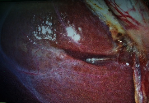 Anatomy of Rouviere's Sulcus and Its Association with Complication of Laparoscopic Cholecystectomy.