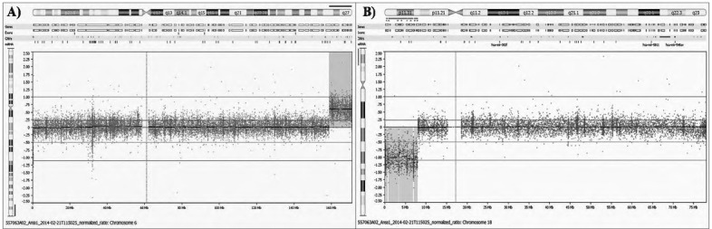 Prenatal Diagnosis of <i>a De Novo</i> Partial Trisomy 6q and Partial Monosomy 18p Associated with Cephalocele: A Case Report.