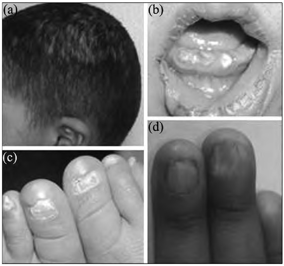 Ankyloblepharon-ectodermal Defects-cleft Lip-palate Syndrome Due to a Novel Missense Mutation in the SAM Domain of the <i>TP63</i> Gene.